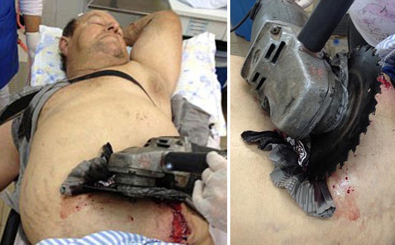 Pisau Gergaji Listrik Menancap di Perut Sedalam 10cm